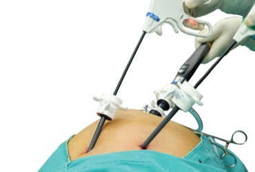 Surgeon Preference Card Review Results In Significant Savings in Lap Chole