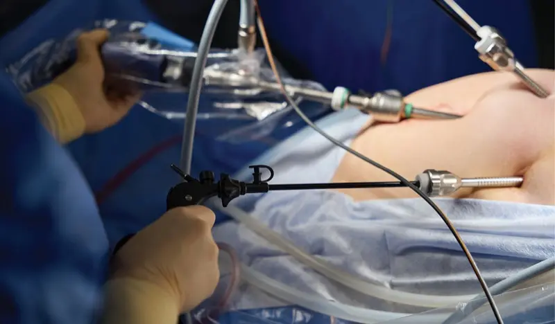 can you have surgery on glp 1 Bariatric Surgery Gold Standard in GLP1 Era